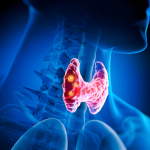 L'Impatto Silenzioso dell'Ipertiroidismo: Come la Malattia di Graves Cambia la Composizione Corporea e le Abitudini Alimentari